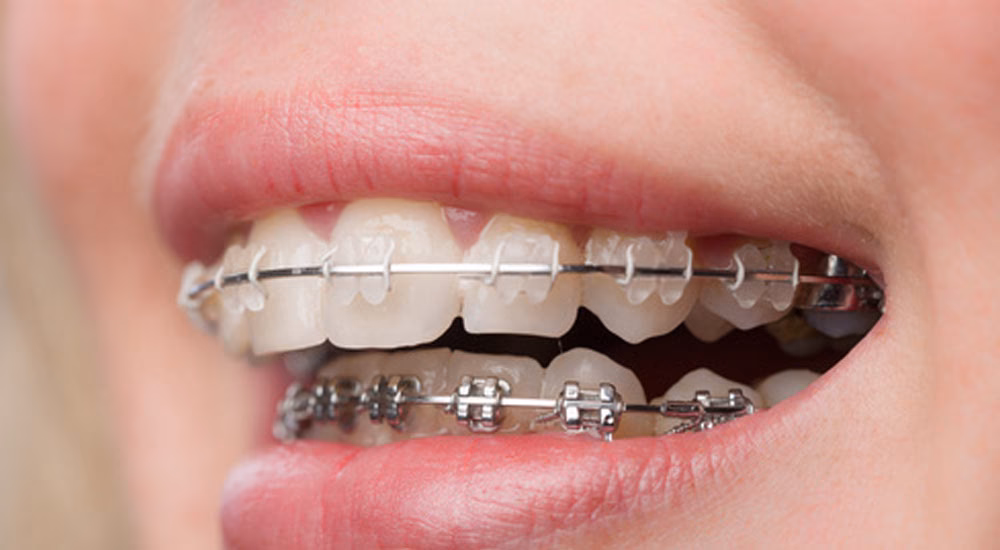 Czy warto zakładać aparat na zęby w wieku 40 lat?