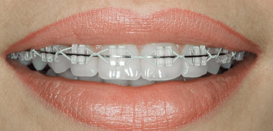 Ile kosztuje aparat stały ceramiczny?