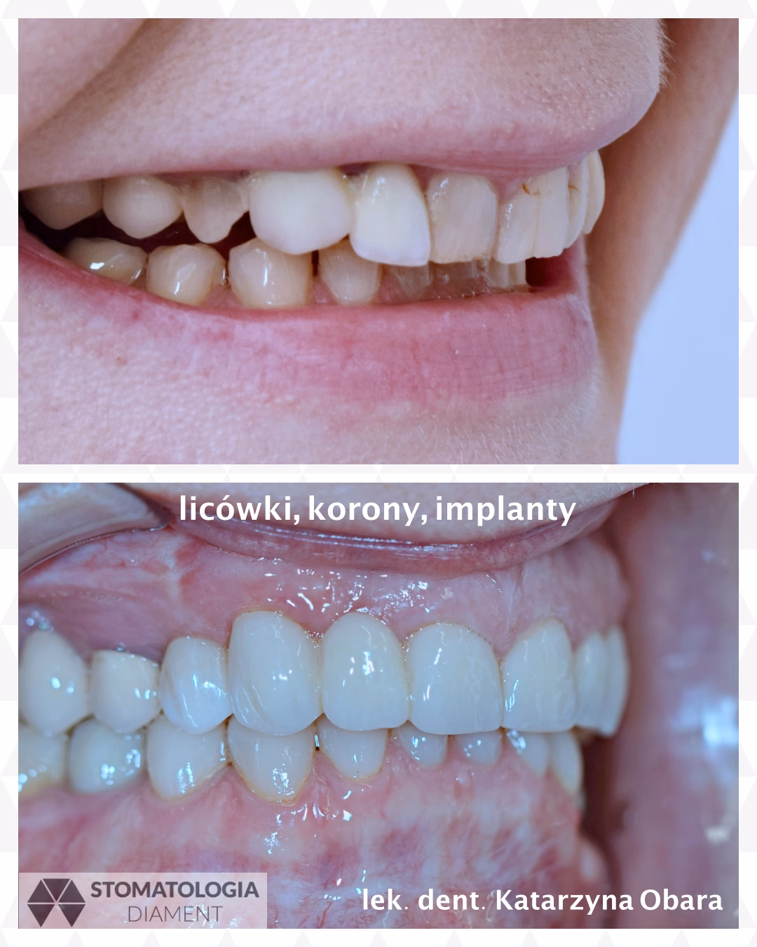 Ile wytrzymują korony ceramiczne?