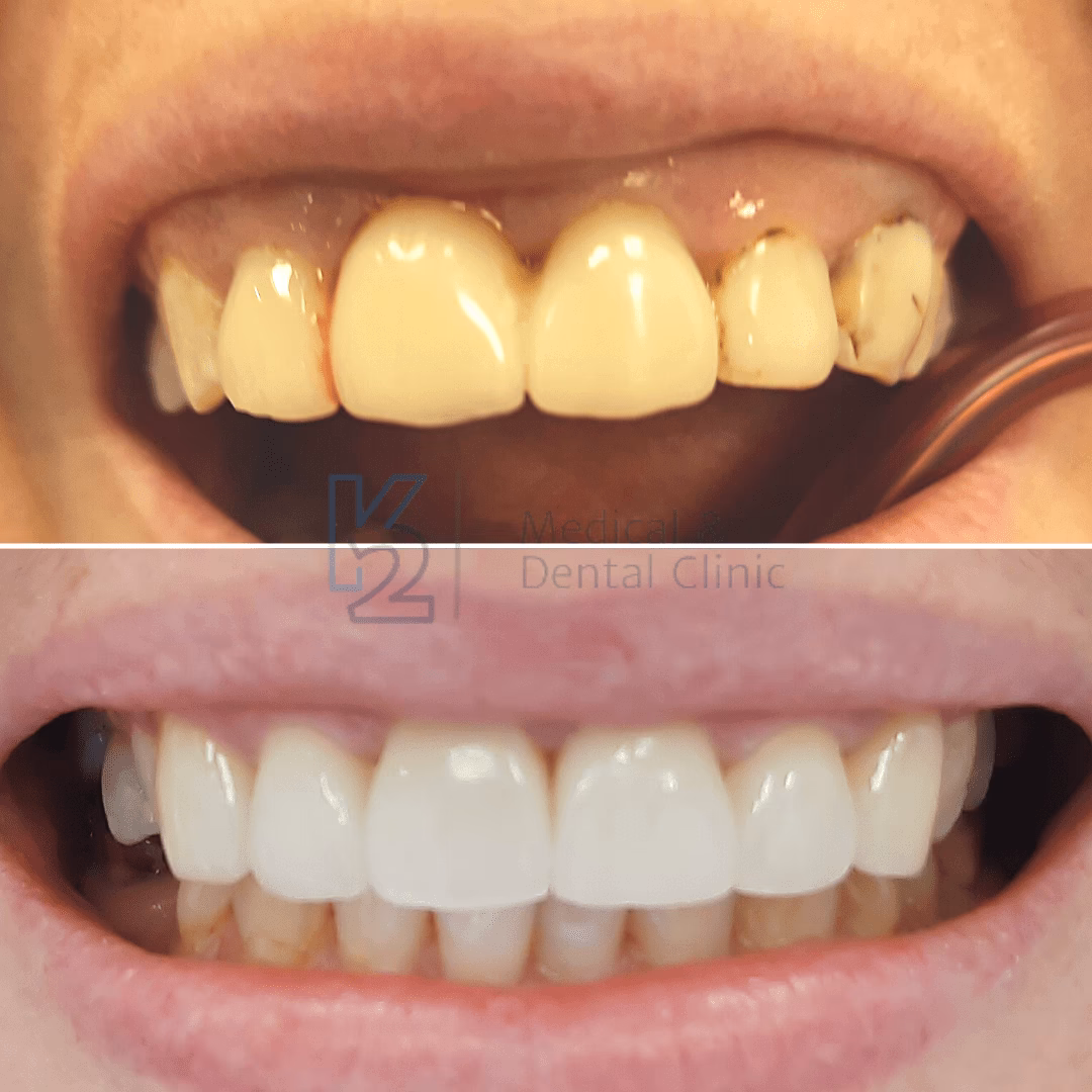 Jak zakłada się korony porcelanowe?