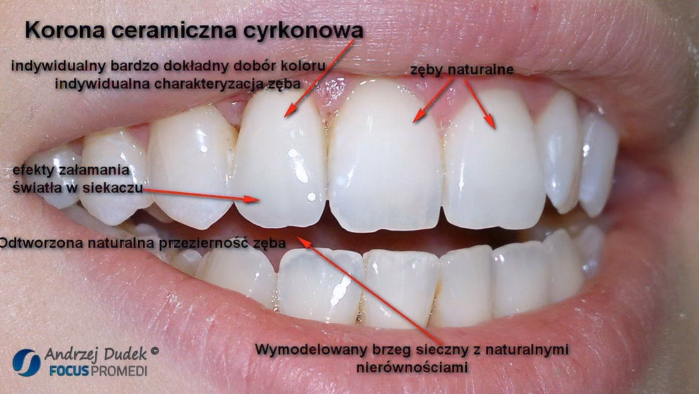 Czym się różni korona cyrkonowa od porcelanowej?