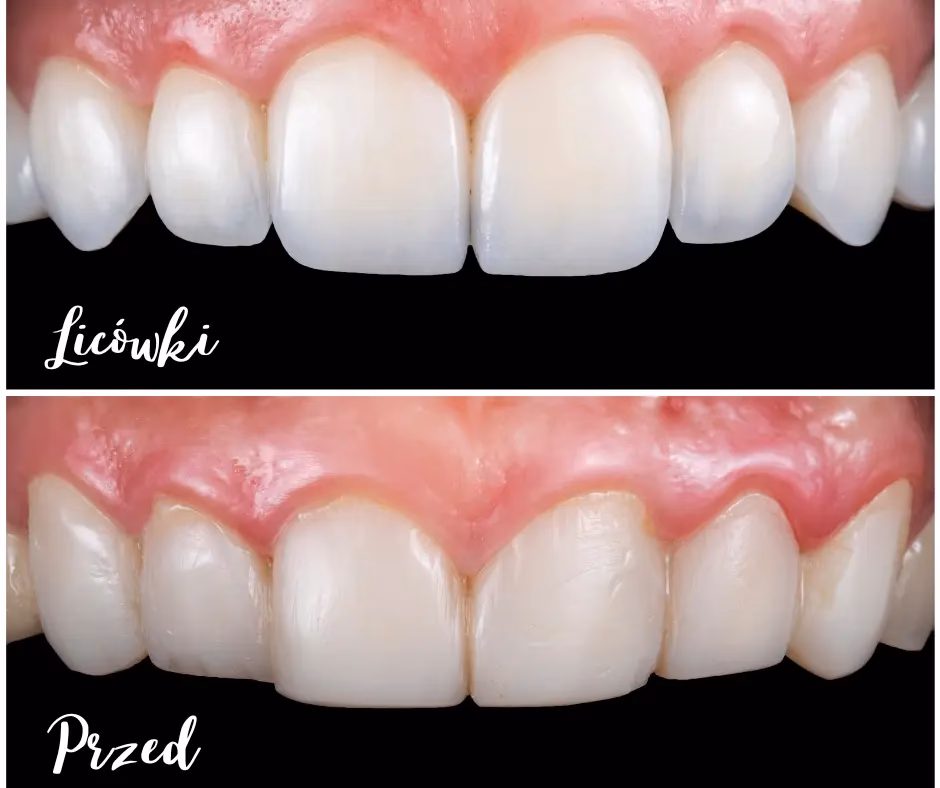 Jaka jest cena licówek na wszystkie zęby w 2025 roku?