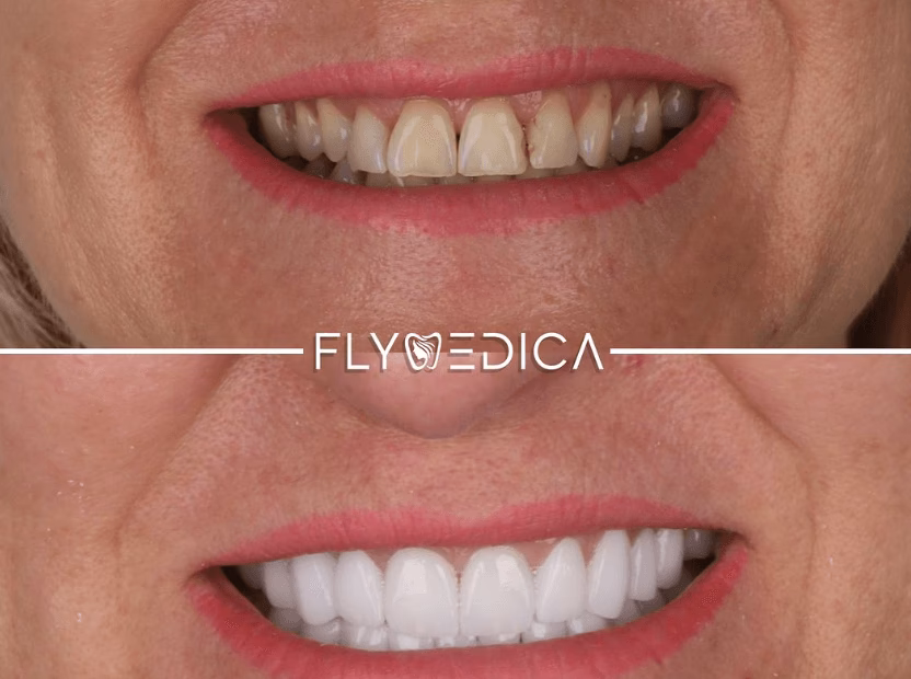 Czy zęby pod licówkami się psują?