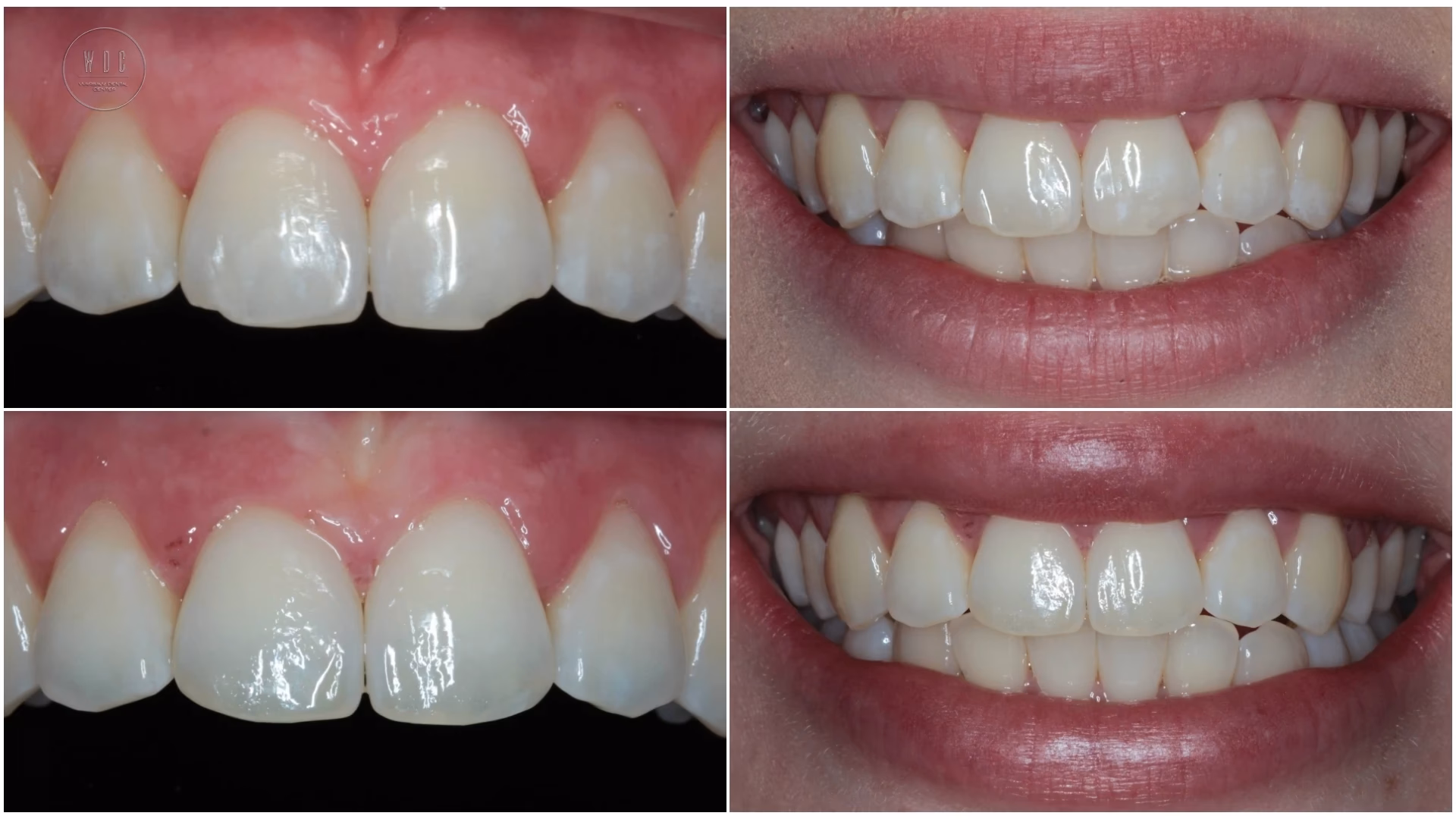 Dlaczego nie robić licówek?