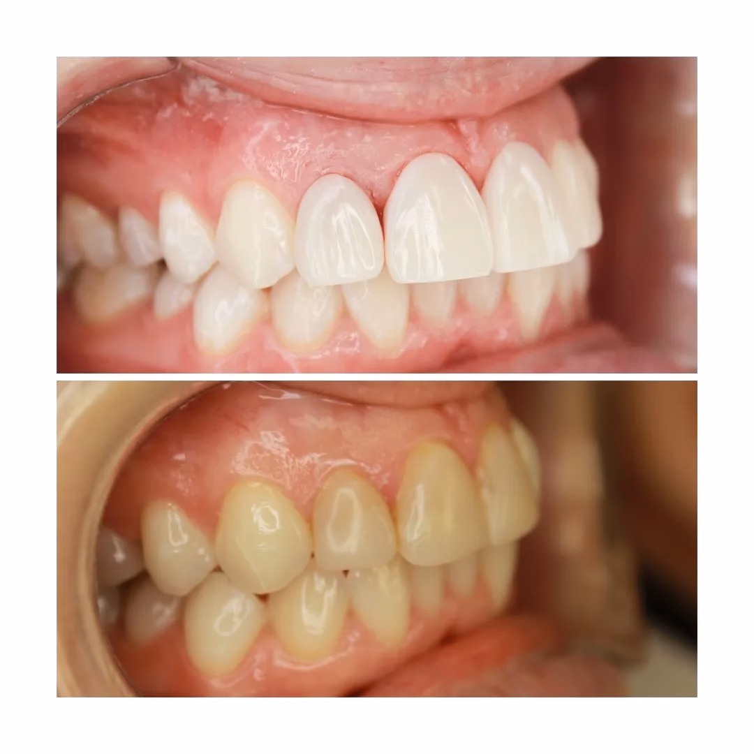 Ile kosztuje licówka na 1 ząb?