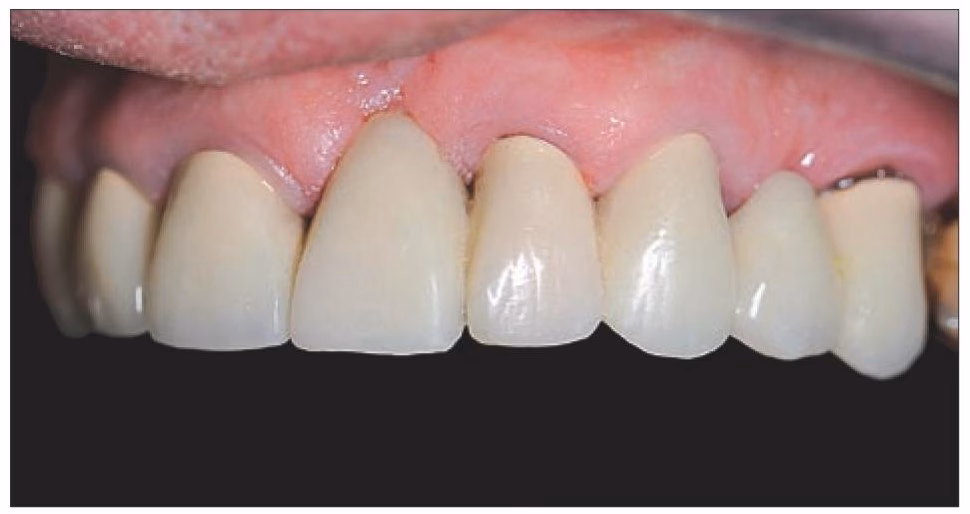 Ile kosztuje most na jednym implancie?