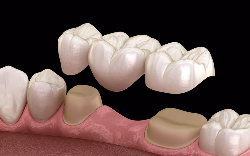 Co jest lepsze koroną czy mostek?
