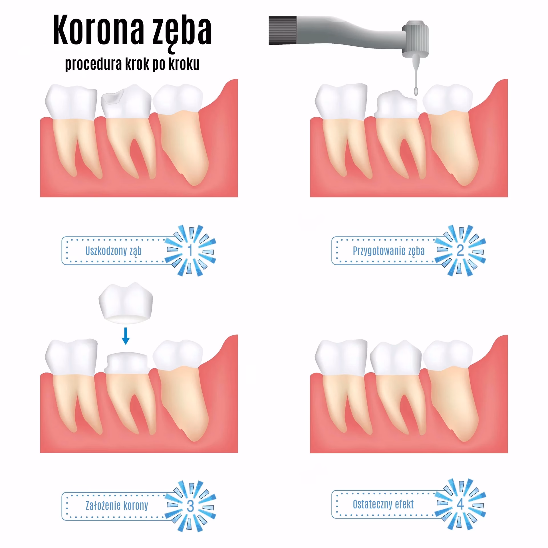 Czy koronę ceramiczną można szlifować?