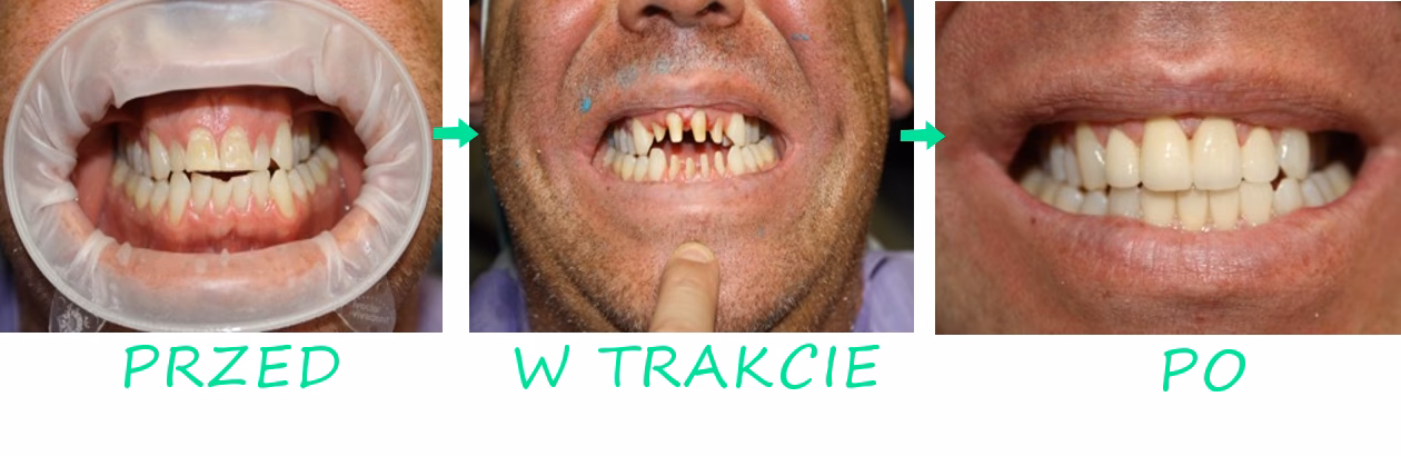 Czy koronę ceramiczną można szlifować?